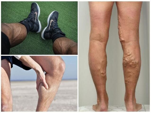bagaimana rupa urat varikos pada kaki lelaki