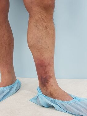 komplikasi daripada urat varikos pada lelaki