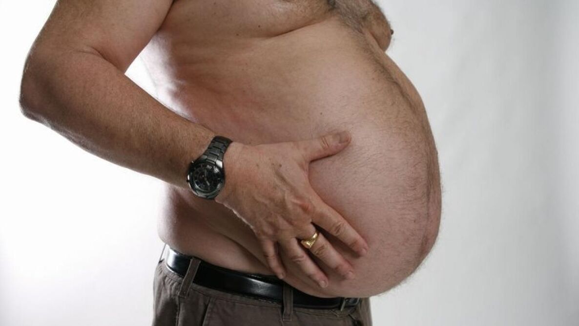 obesiti sebagai punca perkembangan vena varikos
