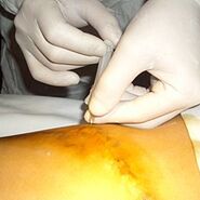 Miniphlebectomy adalah rawatan paling kosmetik untuk vena varikos