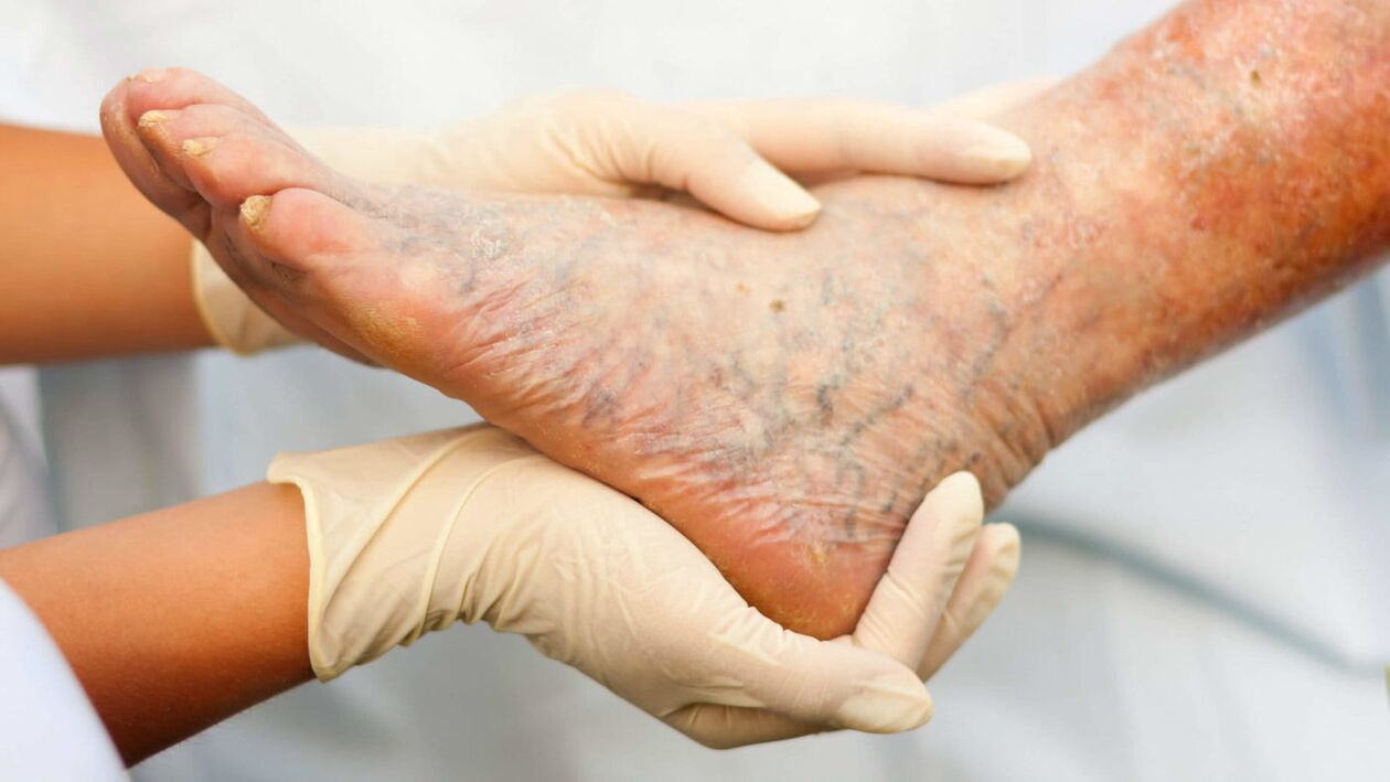 Ahli phlebolog menangani rawatan vena varikos di kaki