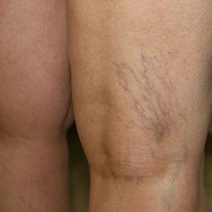 Mesh vena pada bahagian bawah kaki adalah tanda vena varikos