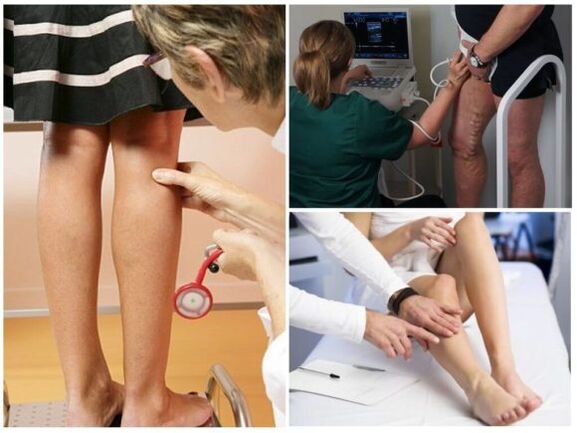 Diagnosis urat varikos