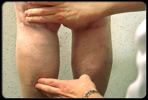 Doktor memeriksa kaki dengan urat varikos