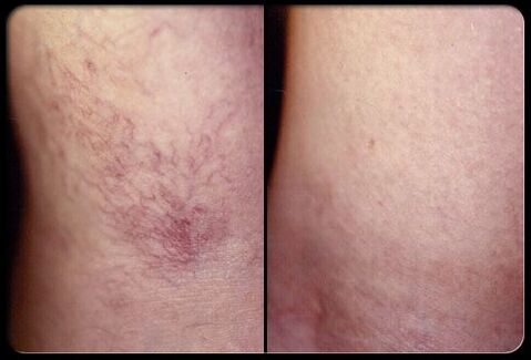 Sebelum dan selepas sclerotherapy