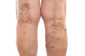 urat varikos pada bahagian bawah kaki